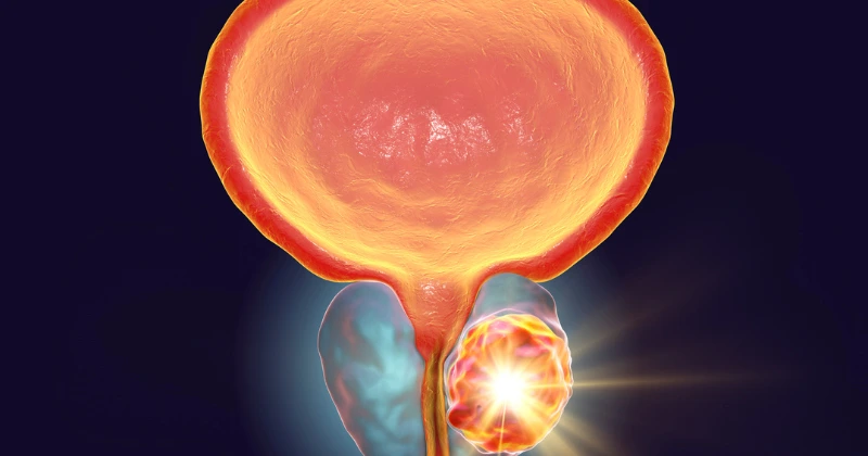 Santé de la Prostate