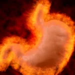 brûlures d’estomac