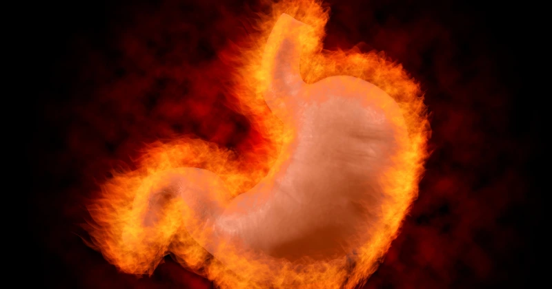 brûlures d’estomac